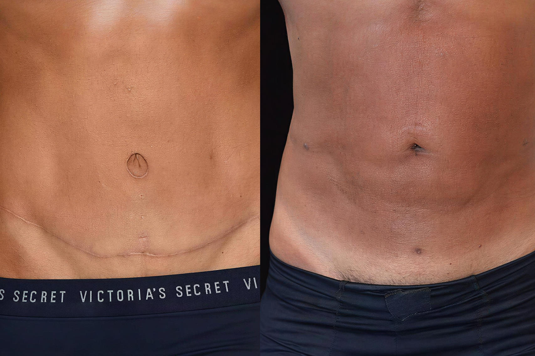 Tummy Tuck vs. Liposuction — Which Procedure Do You Actually Need?